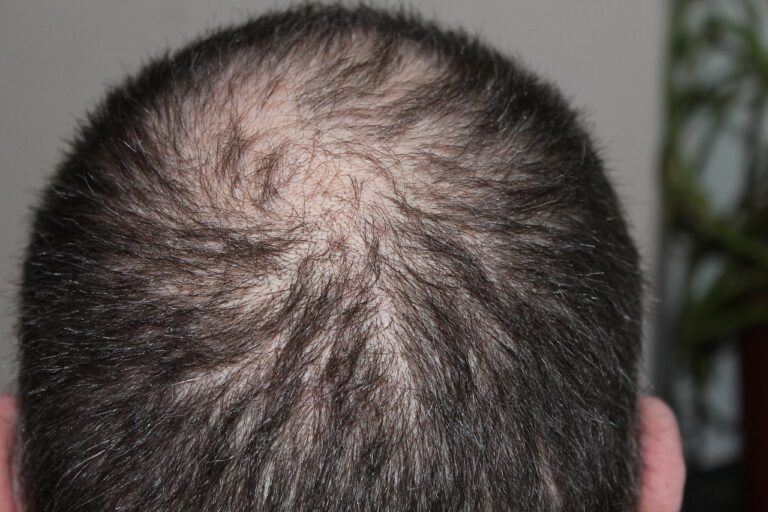 Alopecia Areata (Kreisrunder Haarausfall): Erklärung, Symptome und Ursachen
